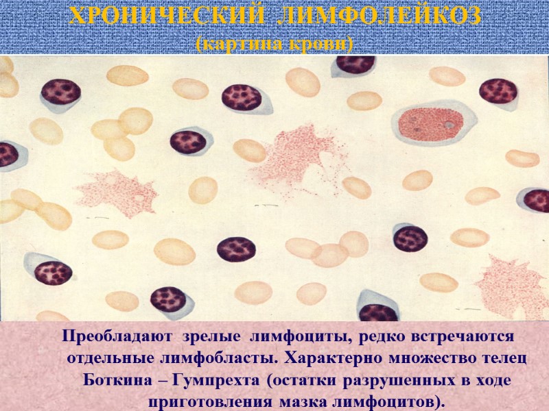 ХРОНИЧЕСКИЙ  ЛИМФОЛЕЙКОЗ (картина крови) Преобладают  зрелые  лимфоциты, редко встречаются отдельные лимфобласты.